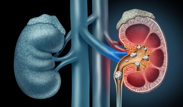 Böbrek Taşı Oluşumunu Engelleme Yolları Nelerdir?
